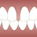 Fechamento de diastema: resina ou alinhadores transparentes?