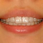 Como funciona o alinhador dental transparente? Ele é melhor que o de metal?  • Ortoestética Epitácio
