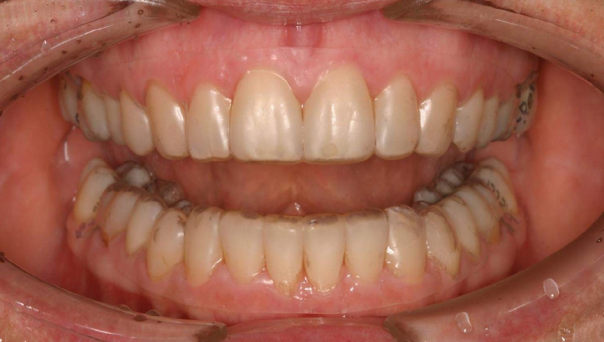 Como funciona o alinhador dental transparente? Ele é melhor que o