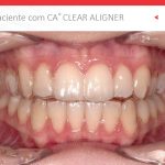 Conheça as atualidades dos alinhadores transparentes