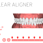 Visualizador do planejamento virtual: saiba como é feito o diagnóstico na CA CLEAR ALIGNER